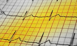 ekg